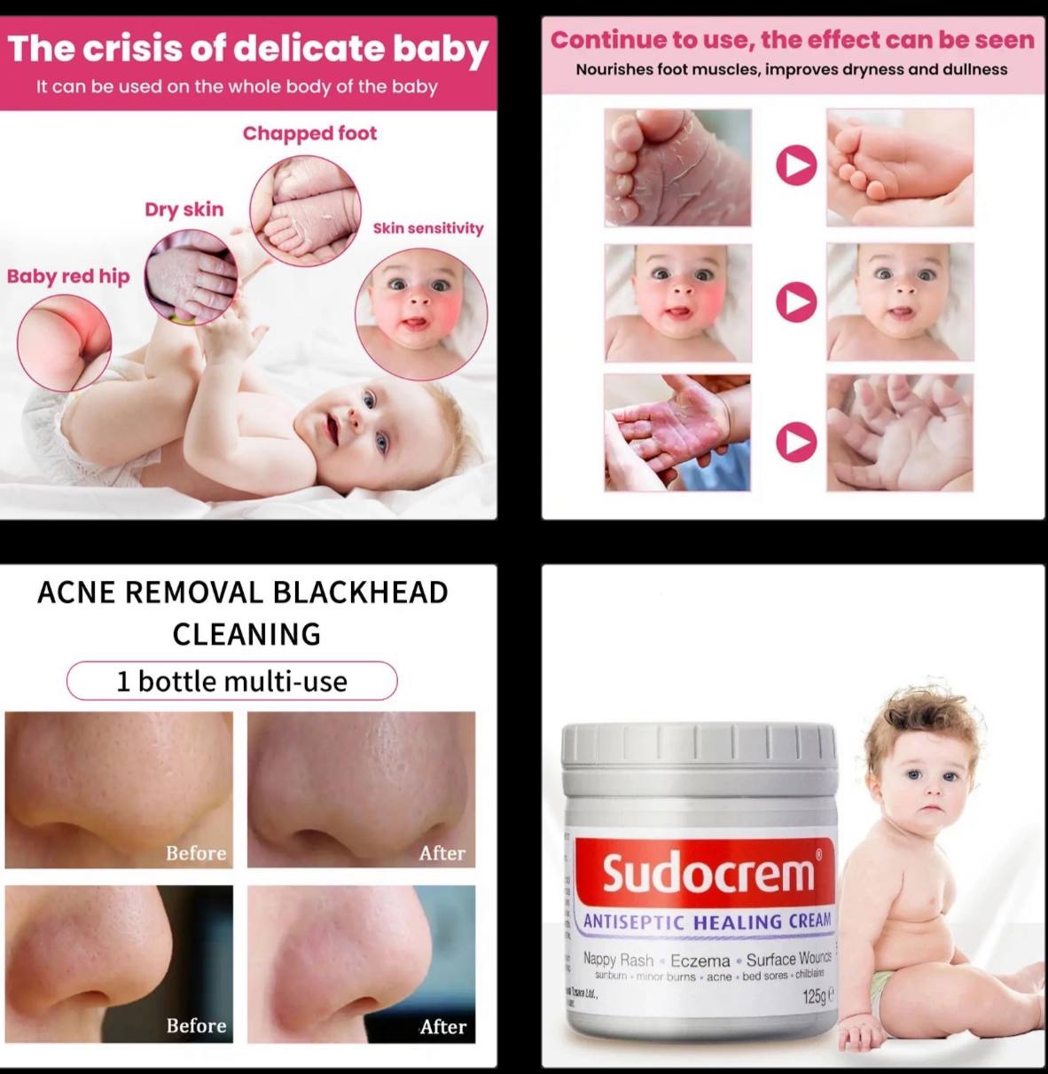 ORIGINAL SUDOCREM ANTISEPTIC HEALING CREAM FOR DIAPER RASH/ECZEMA/SURFACE BURN/SUNBURN & OTHERS SKIN BLEMISHES – 250G